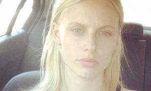 Modelo perdió su pierna por un tampón y podrían amputarle la otra
